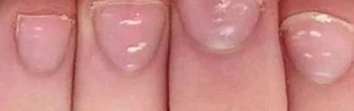 Белые пятна на ногтях — причины и лечение, народные средства