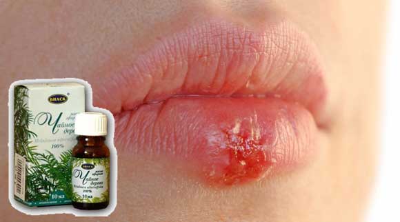 Эфирное масло от герпеса на губах, лечение в домашних условиях