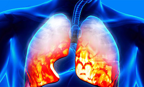 Пневмония: симптомы и лечение у взрослых, ингаляции с маслами