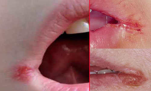Причины трещин в уголках рта — фото, лечение, препараты и народные методы