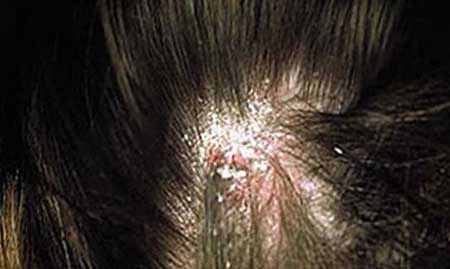 Псориаз на голове: причины, симптомы, лечение народными способами